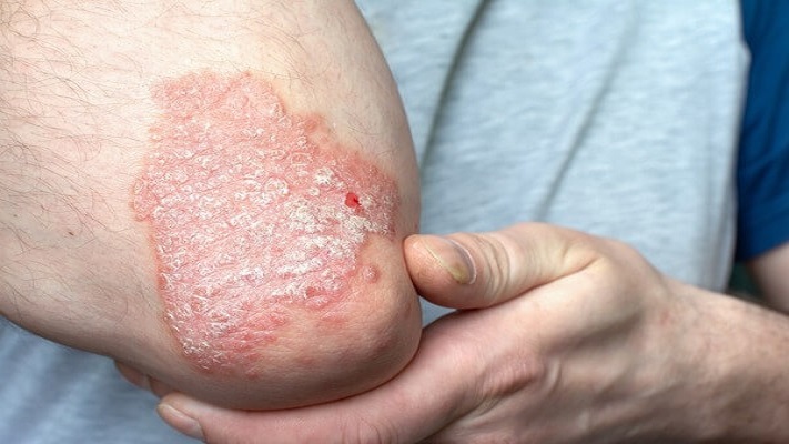 Charla abierta y gratuita sobre enfermedad psoriática